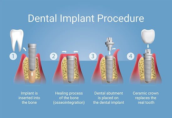 Dental Implant Procedure