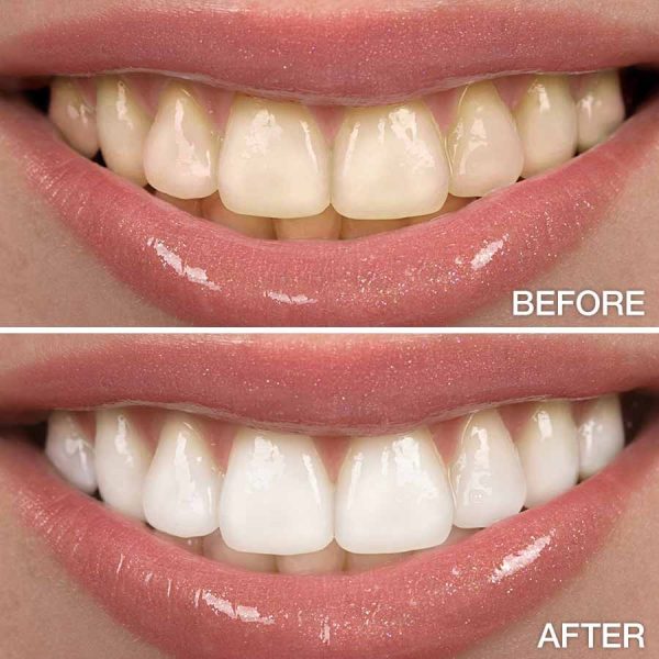 Tooth Whitening