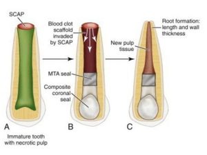 211215014437RegenerativeEndodonticProcedure 1