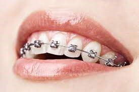 Braces Aligner