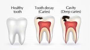 Dental Caries