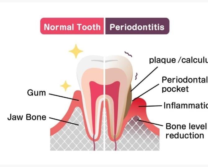 Gum & Periodontal Disease