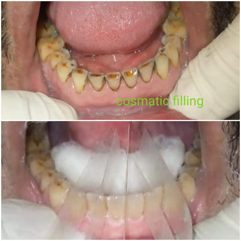 Tooth Surface Loss Management Odontology Inn