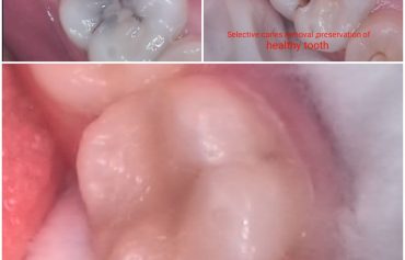 Tooth Color Filling