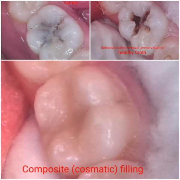 Tooth Color Filling