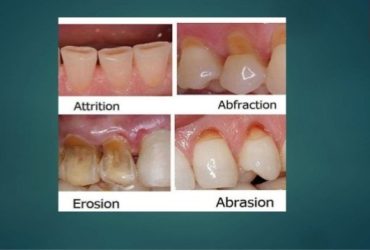 Tooth Surface Loss Management