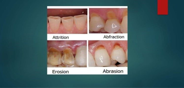 Tooth Surface Loss Management
