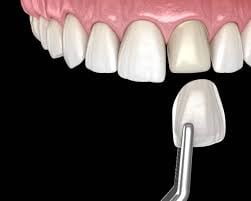 Tooth Veneer